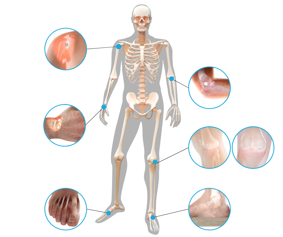 S-Core® is a versatile platform for osteochondral reconstruction